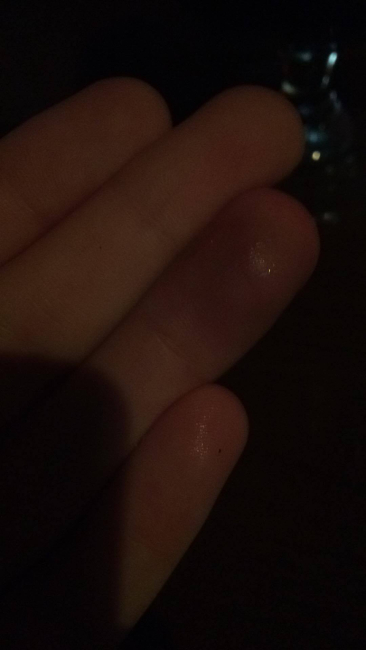 I hurt my finger